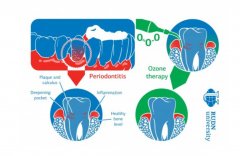 RUDN 大学牙医建议采用基于臭氧的综合抗炎疗法